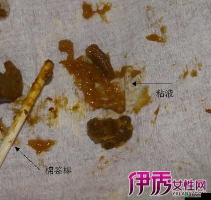 男生没开始就有粘液：正常现象还是健康问题？